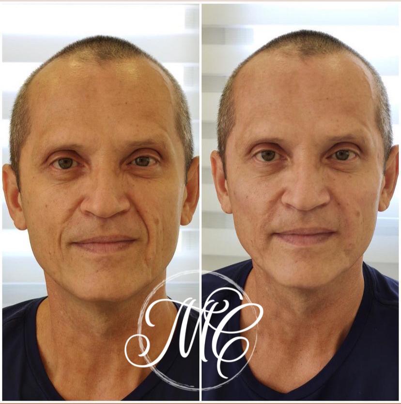 Dra Marcelly Chue - protocolo bioestimuladores