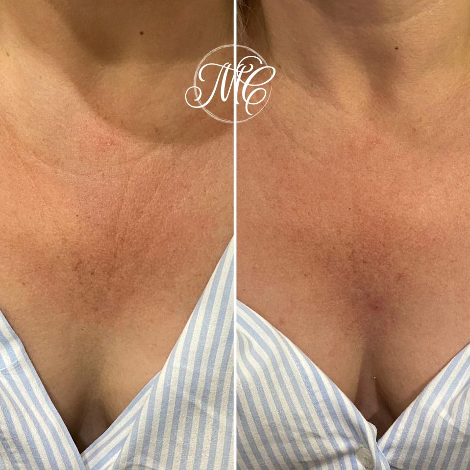 Dra. Marcelly Chue - Bioestimuladores de colágeno