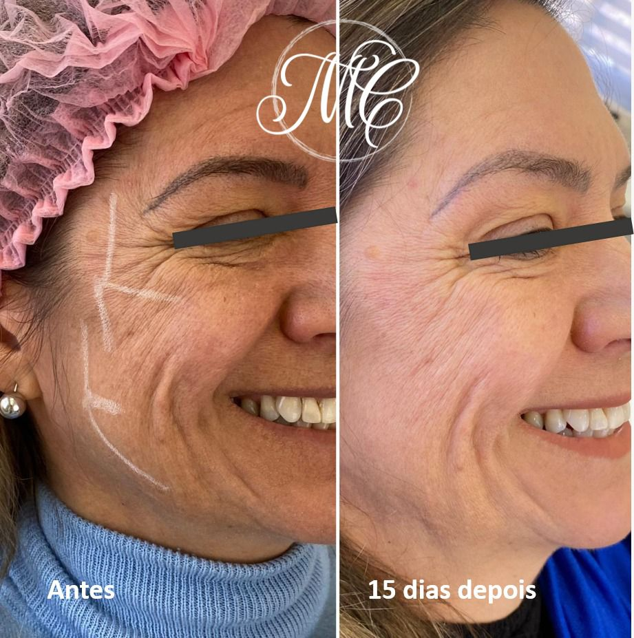 Dra. Marcelly Chue - Bioestimuladores de colágeno