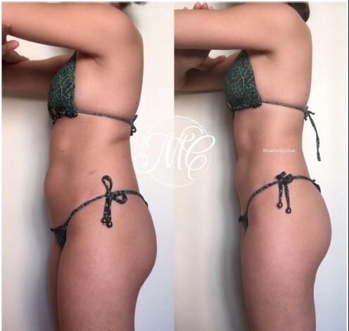 Dra. Marcelly Chue - Lipo Enzimática