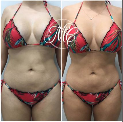 Dra. Marcelly Chue - Lipo Enzimática