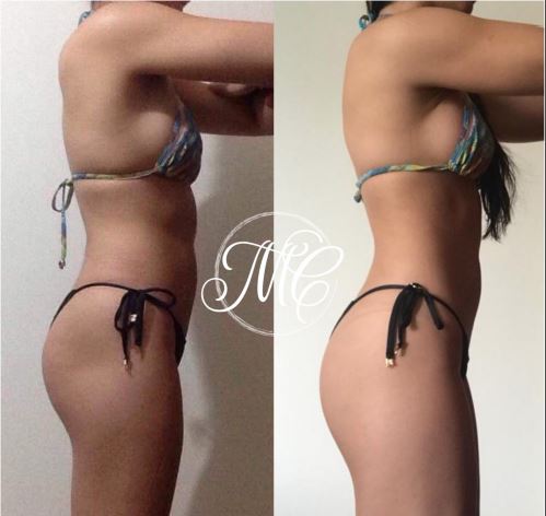 Dra. Marcelly Chue - Lipo Enzimática